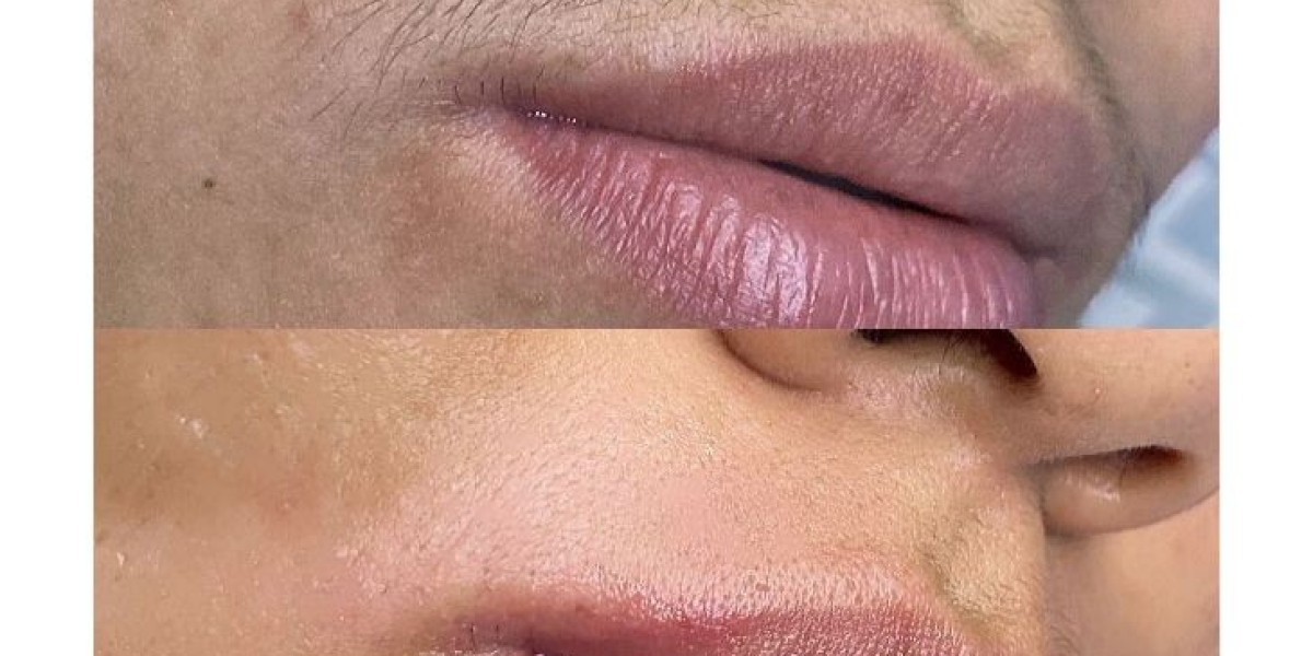 Laser Hair Removal – The Smart Way to Achieve Smooth Skin