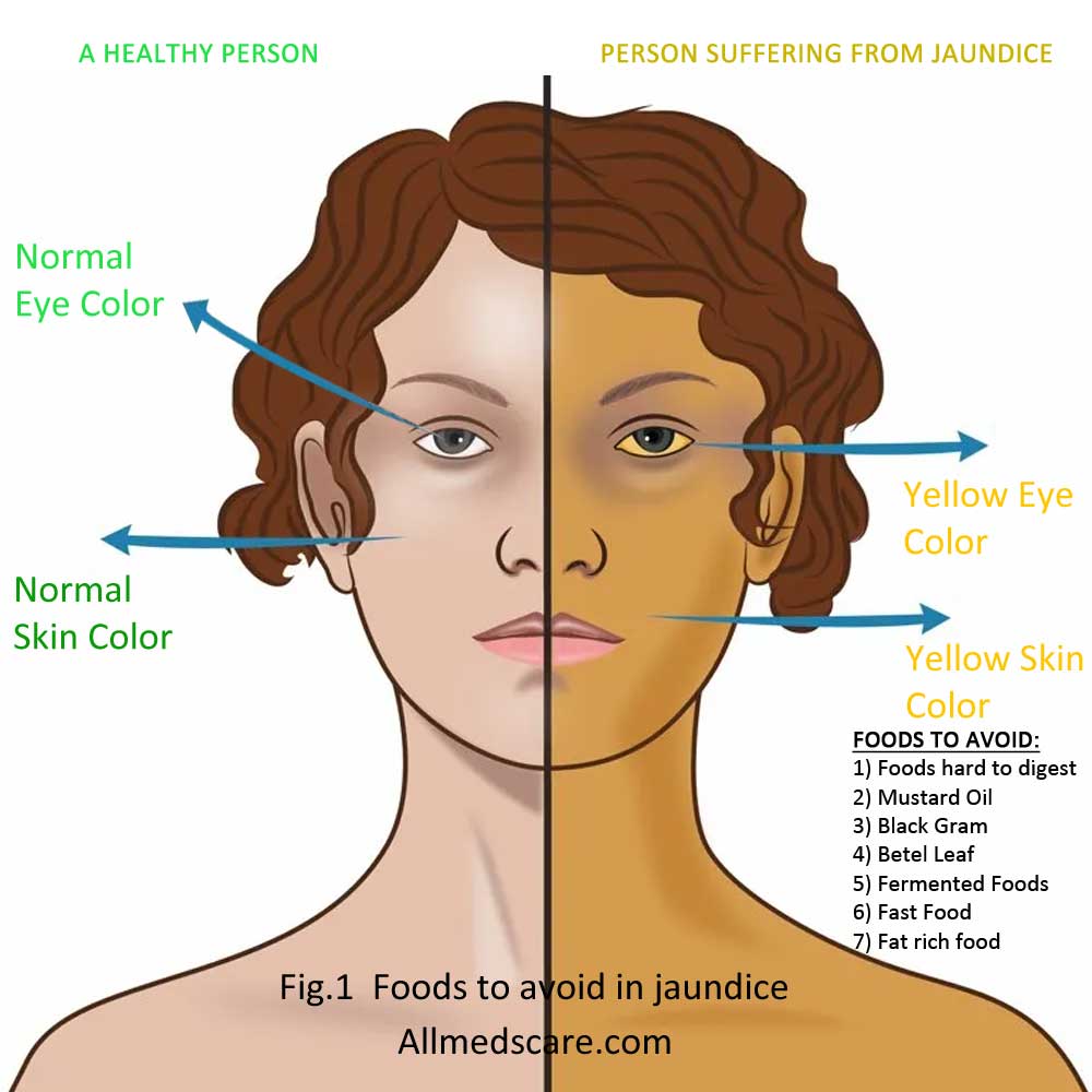 Jaundice Symptoms & Foods to Avoid- Allmedscare.com