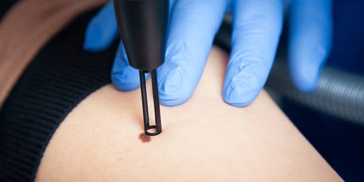 Understanding Different Types of Warts Before Removal