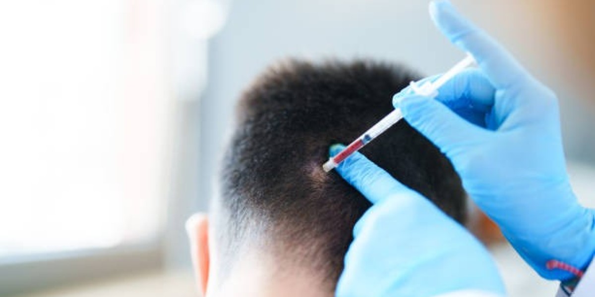 PRP Hair Treatment Guide for Optimizing Follicle Stimulation Results