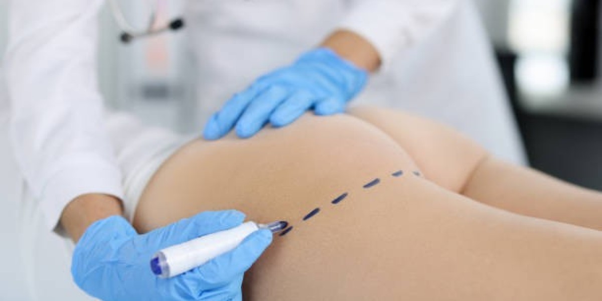 Does Liposuction Deliver Permanent Results in Riyadh?