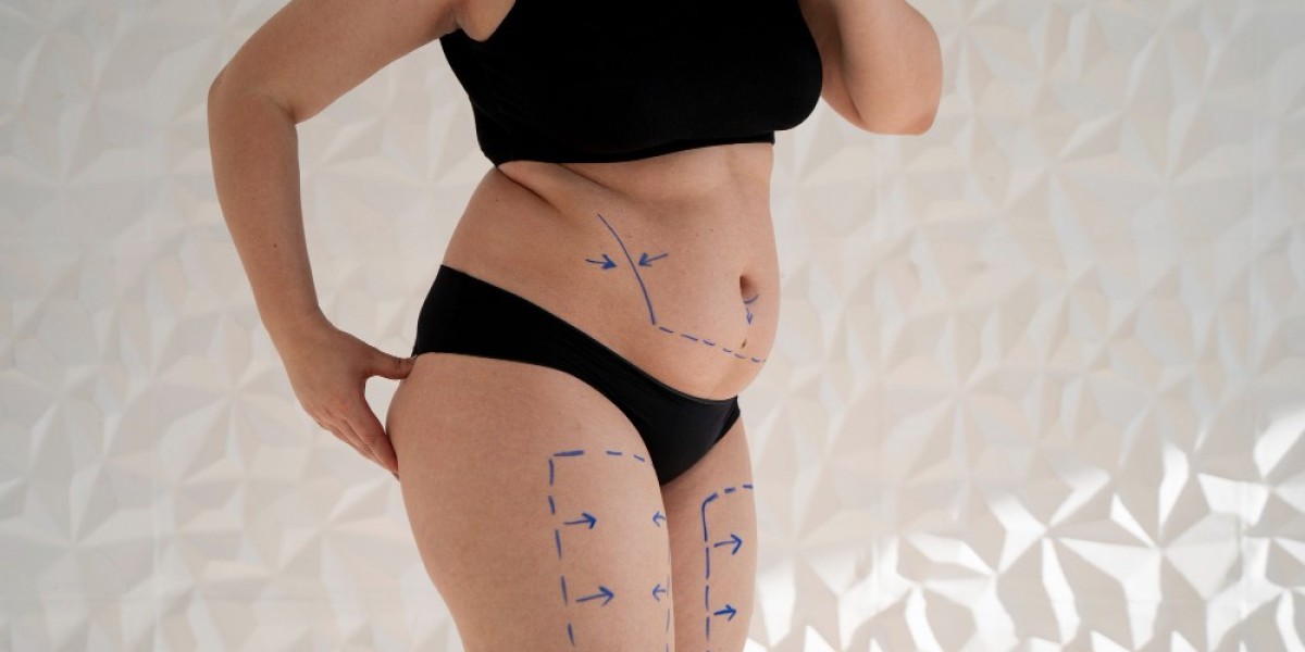 How Liposuction Boosts Confidence and Body Image