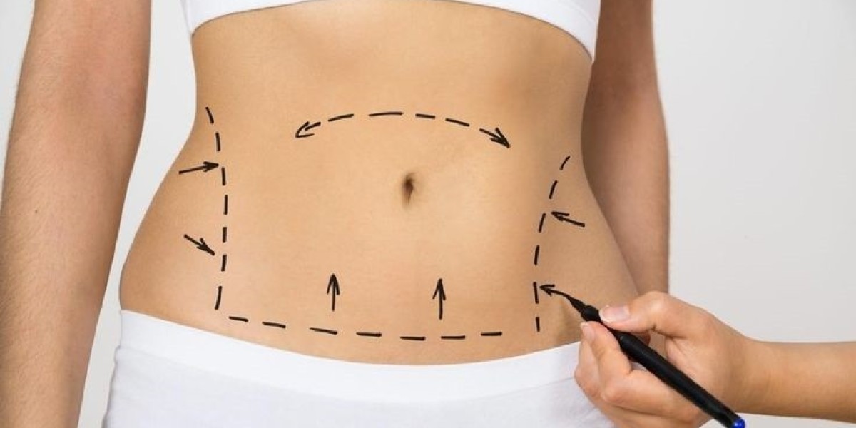 Liposuction for Better Body Confidence and Shape