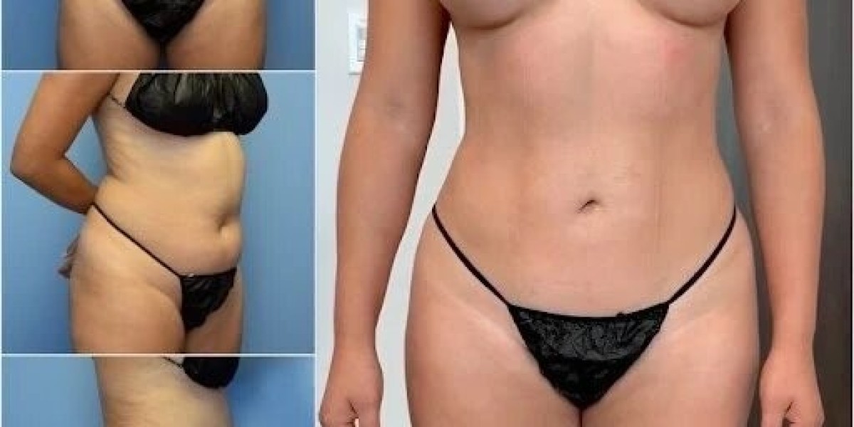 Ideal Shape Begins with Best Body Contouring Surgeon in Dubai