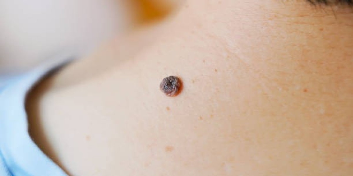 How Wart Removal Can Improve Skin Texture Naturally