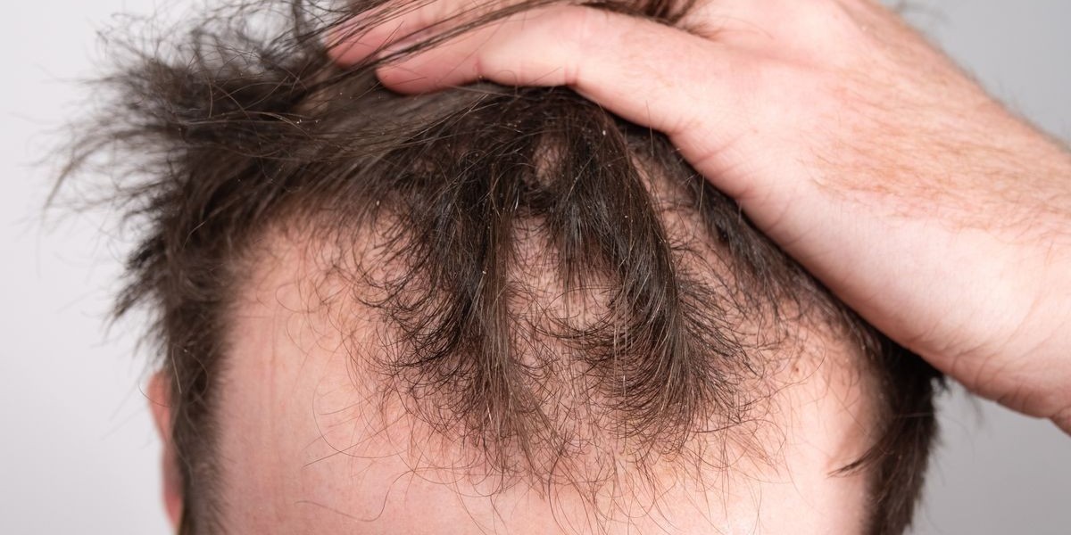Exosome Therapy: The Next Evolution in Hair Loss Solutions