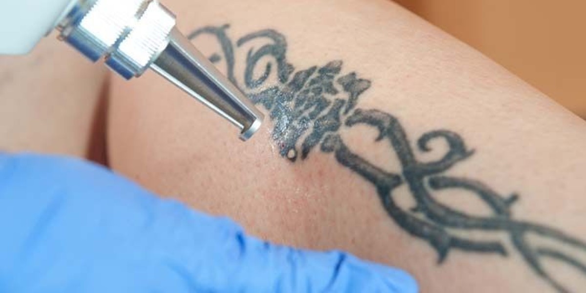 Say Goodbye to Ink: Laser Tattoo Removal Explained