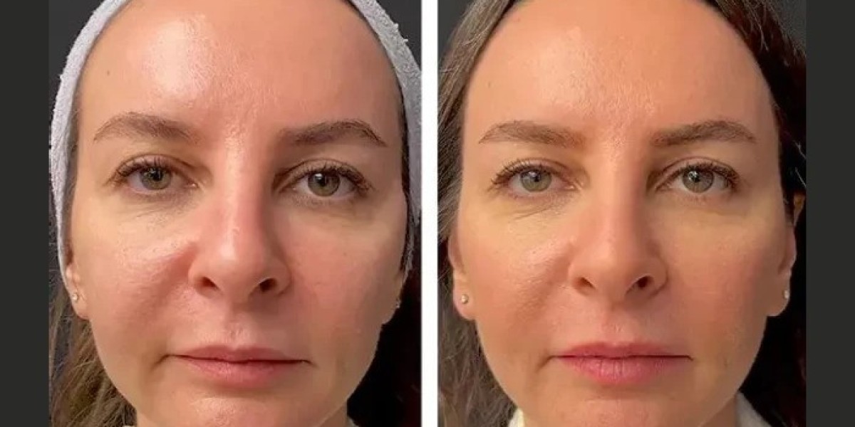 Best Aesthetic Clinics in Dubai for Mesotherapy Treatment: A Complete Guide