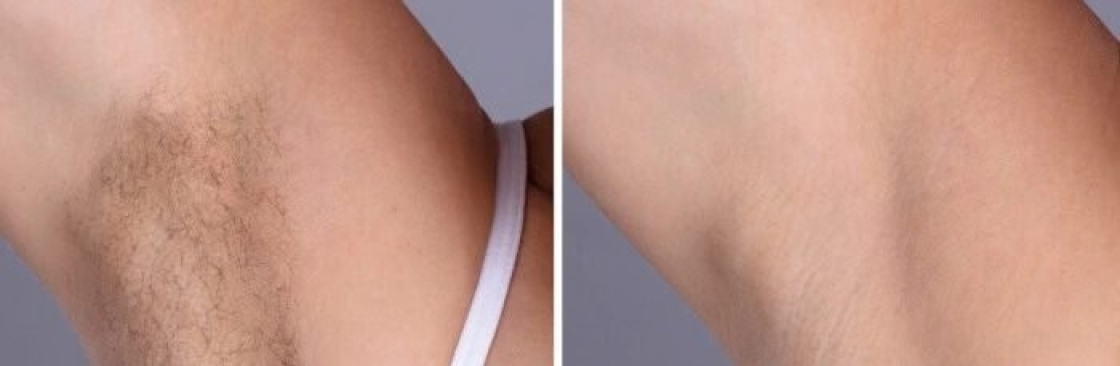 Laser Hair Removal Cover Image