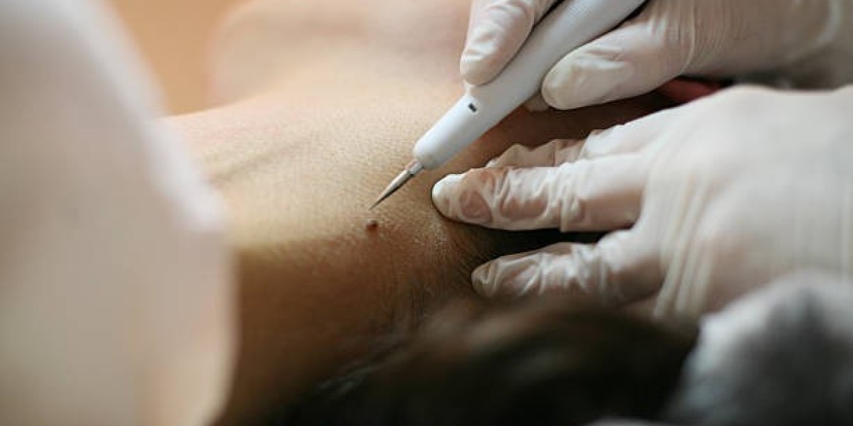 Budget vs Premium Skin Tag Removal: What Really Matters?