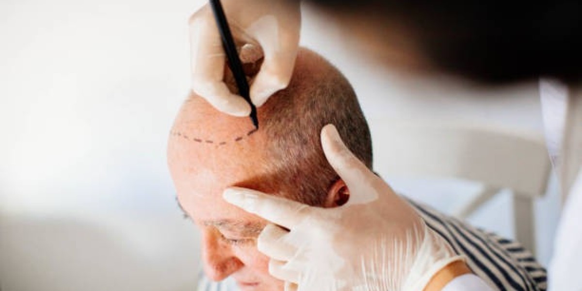 Hair Transplant Insights for People Struggling With Baldness