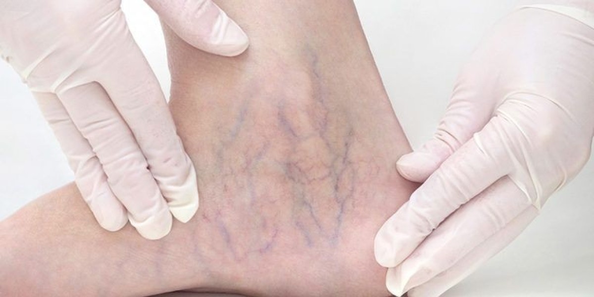 Expert-Led Varicose Veins Treatment at Royal Clinic