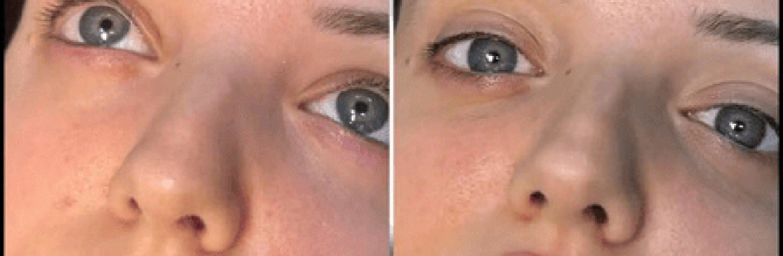 dermal fillers Cover Image