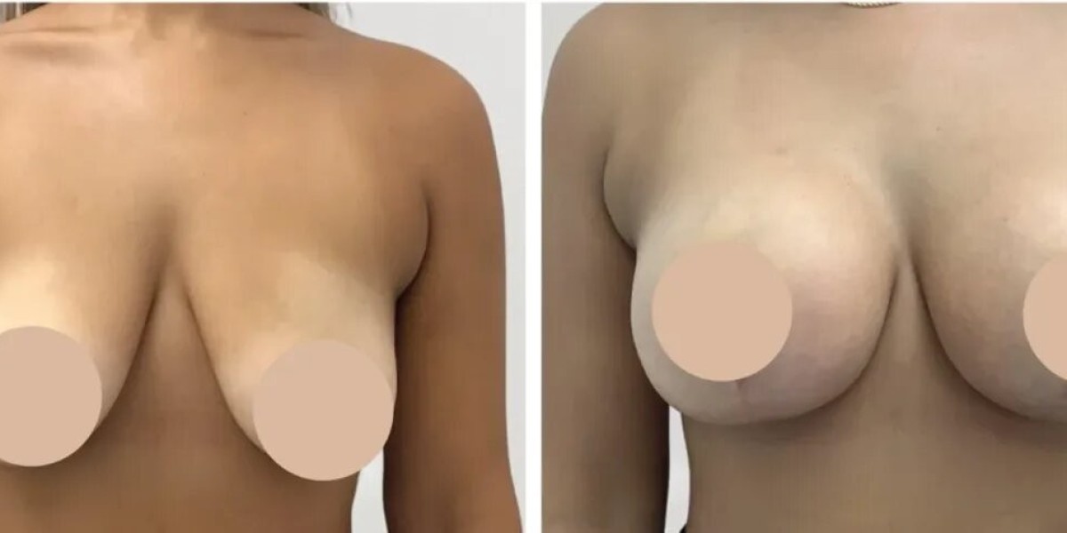 Best Breast Reduction Surgeon in Dubai for Lasting Confidence