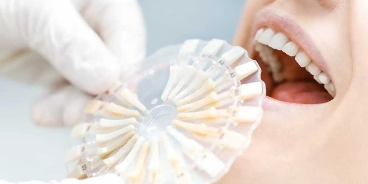 Affordable Teeth Whitening Options in Mississauga Without Compromising Safety