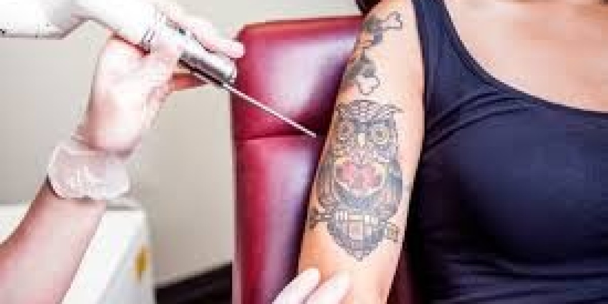 Laser Tattoo Removal in Islamabad for Sensitive Skin: Safety Guide