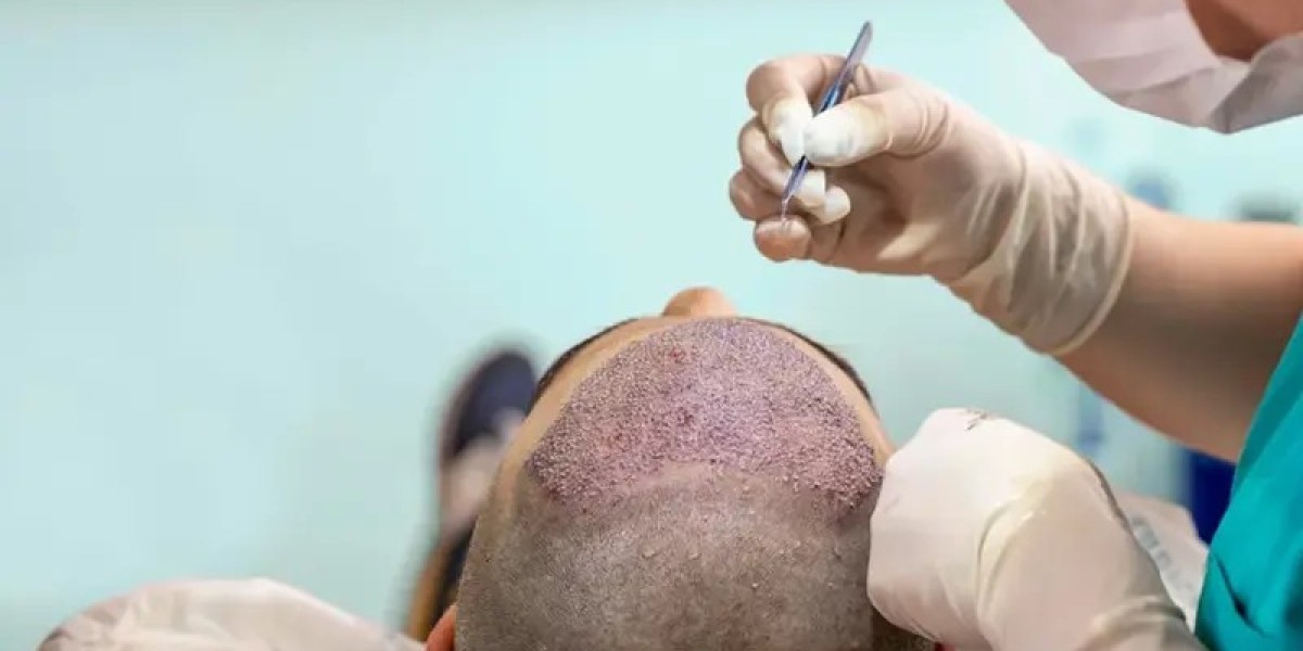 How Does Hair Transplant in Dubai Support Natural, Strong Hairlines?