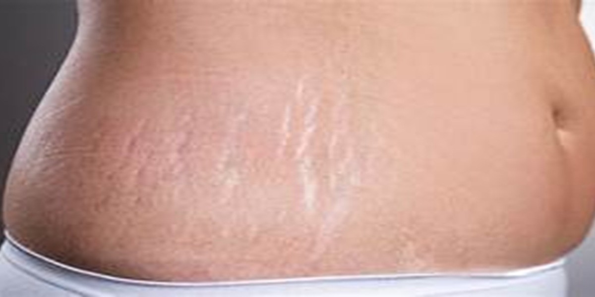 Stretch Mark Removal Treatment in India: Modern, Non-Surgical Solutions, Safe & Proven Methods | Essence Skin Care