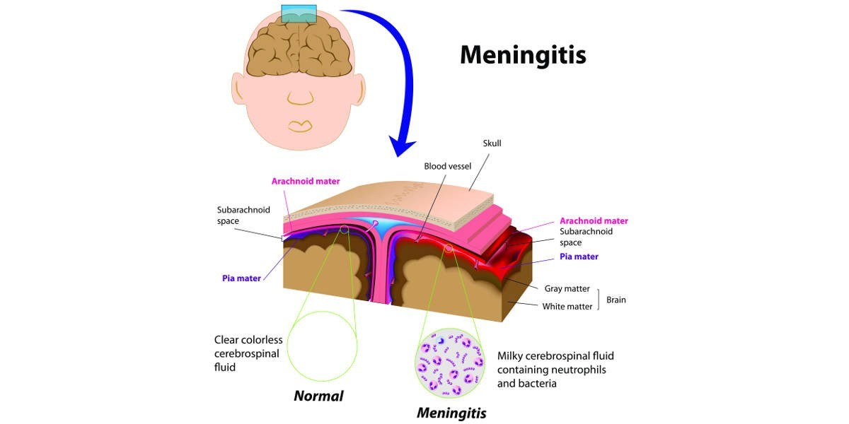 What Are the Causes and Symptoms of Meningitis?