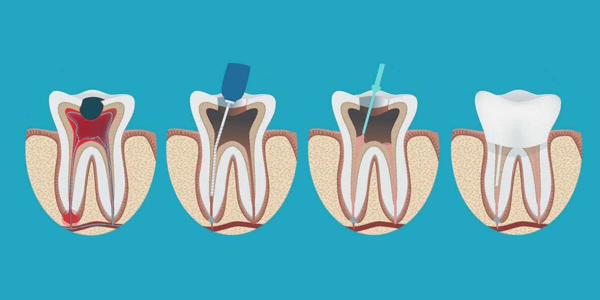 Smart Ways to Use Coverage for Stress-Free Root Canal Treatment