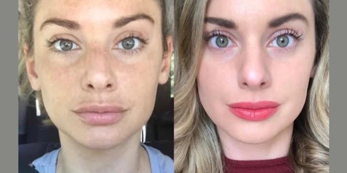 Best Doctors in dubai: Radiofrequency Microneedling for Smooth and Firm Skin