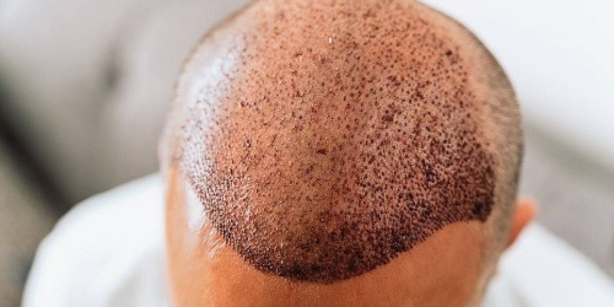 Hair Transplant in Riyadh: Restore Volume