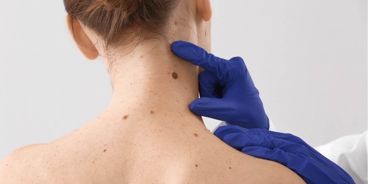 Dermatologist Solutions for Removing Skin Moles