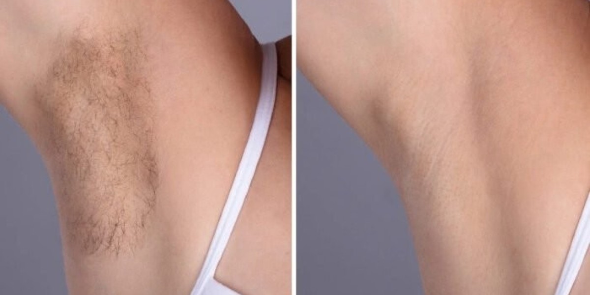 Best Doctors in dubai for Electrolysis Laser hair removal: Dark & Light Skin