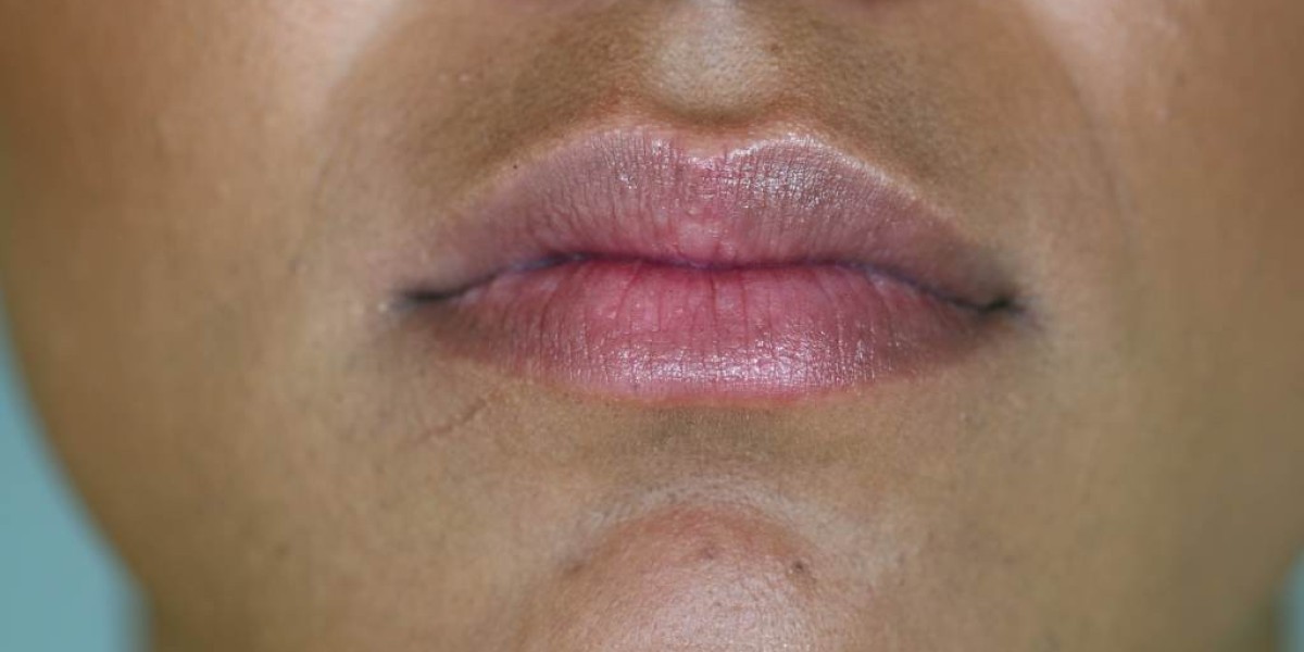 Dark Lips Causes and How Laser Treatment Addresses Them