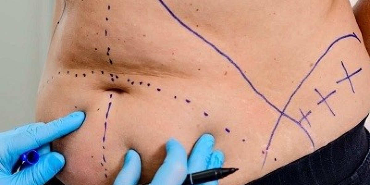 Liposuction in Riyadh for a Defined Waistline
