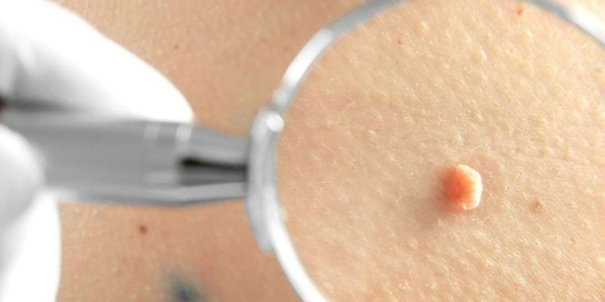 Modern Techniques for Moles Removal in Dubai