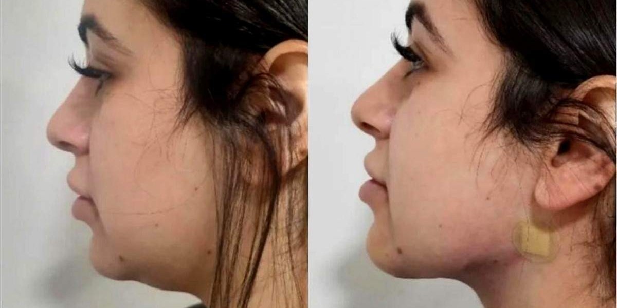 Flawless & Youthful: Chin Lipo Treatment in Islamabad