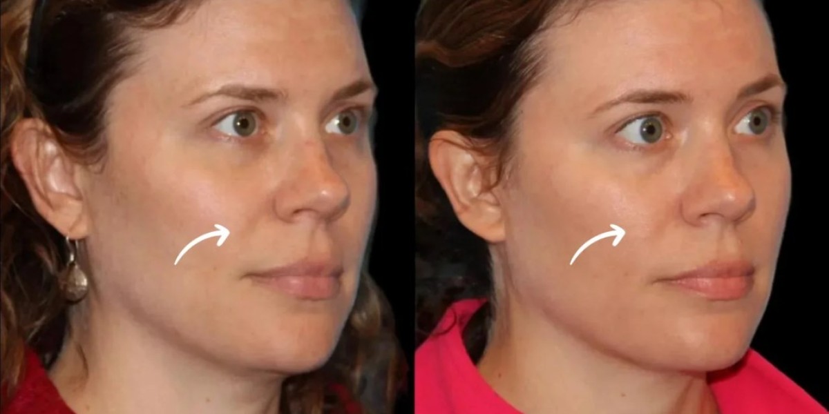 Sculptra Beauty Planning by Best Plastic Surgeon in Dubai