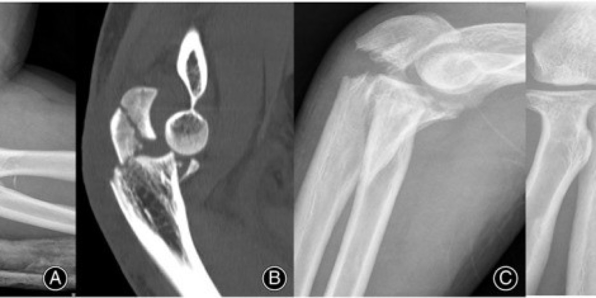 Understanding Fractures & Dislocations: Early Warning Signs
