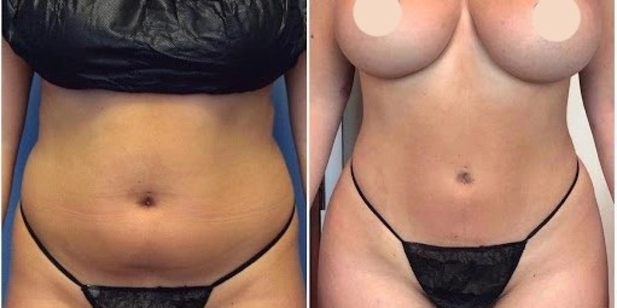 Discover New Confidence with J-Plasma Treatment in Dubai