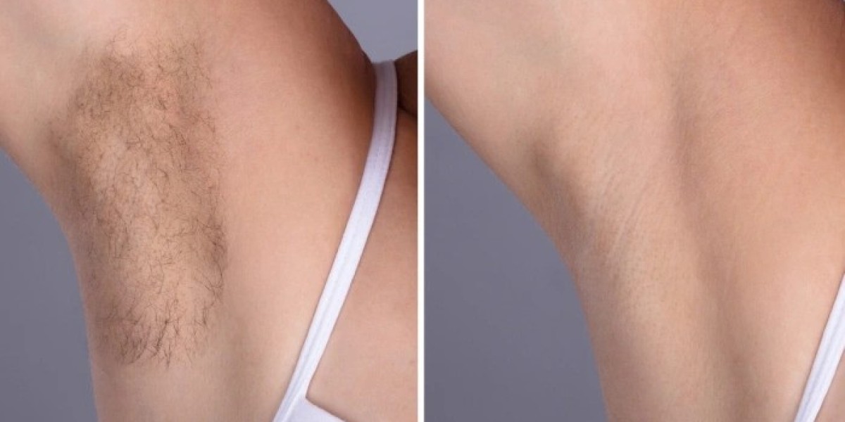 Laser hair removal in Dubai for Dark and Light Skin