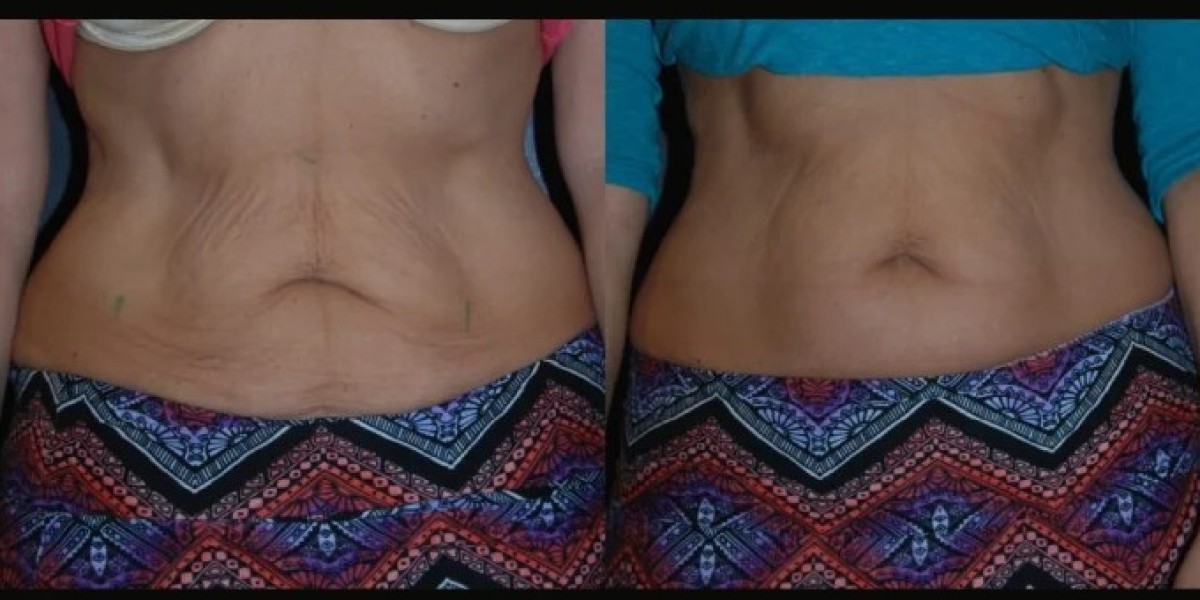 Is Skin Tightening Treatment in Dubai Painful?