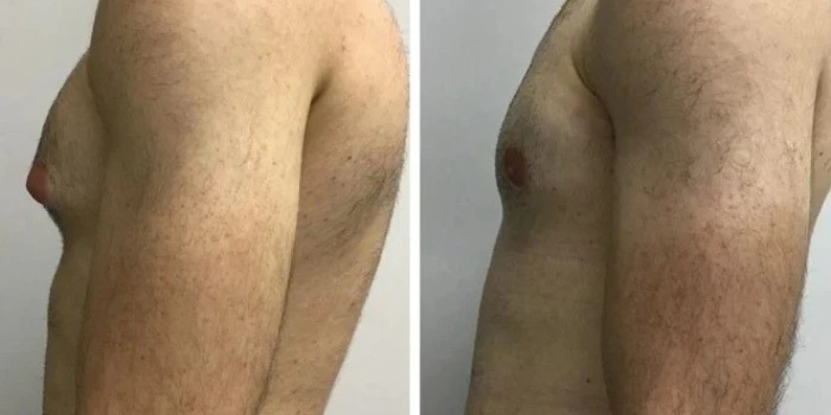 Best Gynecomastia Surgeons in Dubai Delivering Surgical Excellence